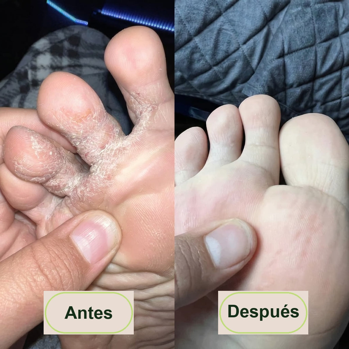 Antes y después - hongo entre los dedos del pie